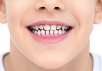 Мезиальный прикус у ребенка: все, что нужно знать родителям для сохранения здоровья улыбки